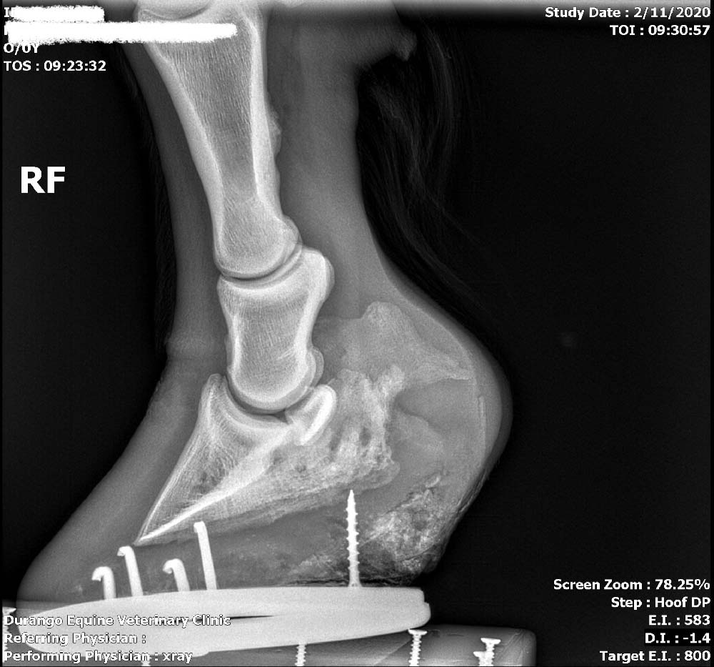 This horse presented for a lameness and radiographs were taken and a keratoma, or
mass in the hoof capsule, was found.